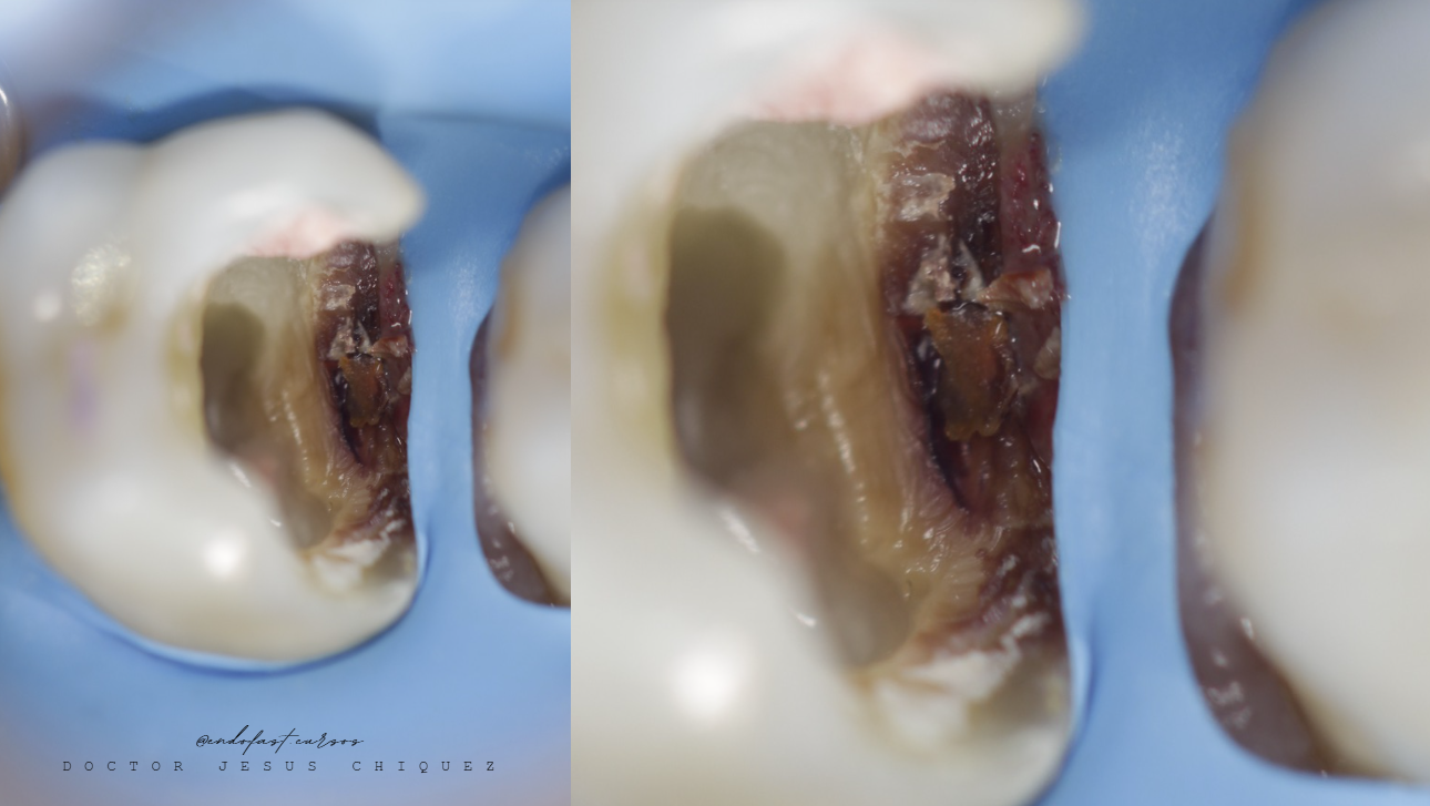 Fotografías clínicas originales del módulo 1: evaluación de una restauración proximal