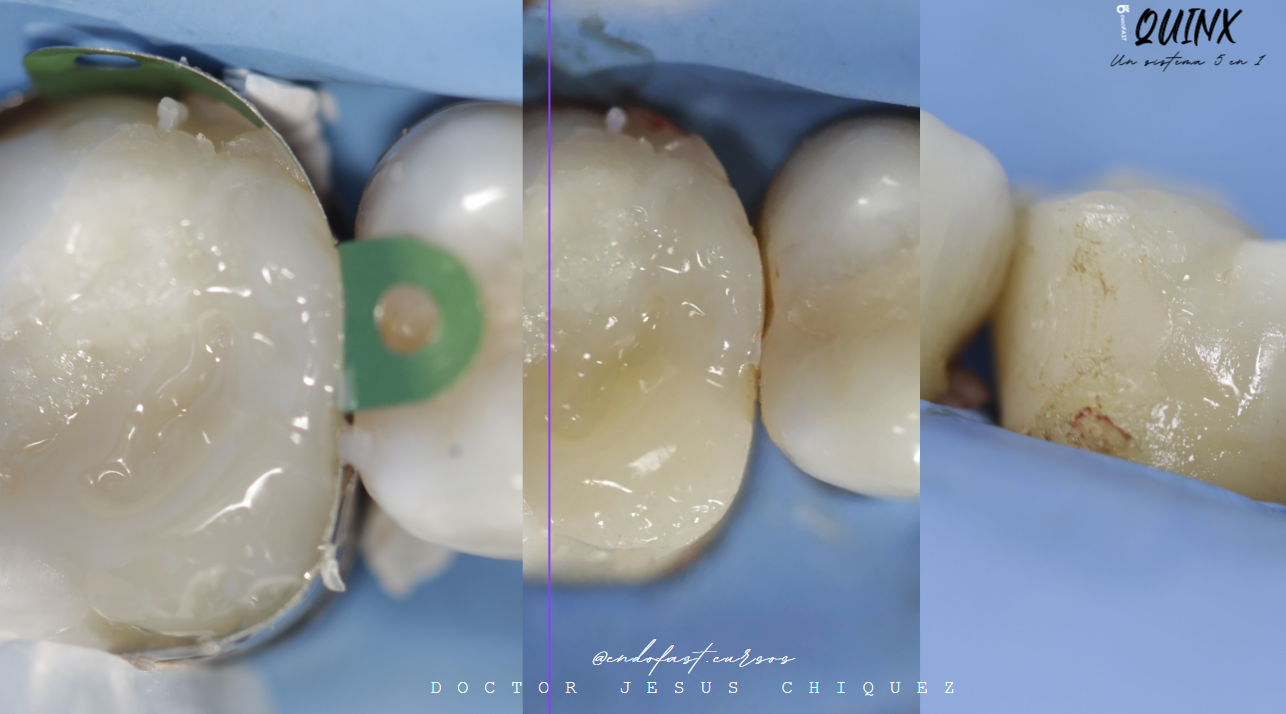 Fotografías clínicas originales del módulo 3: revisión y acabado de la restauración proximal